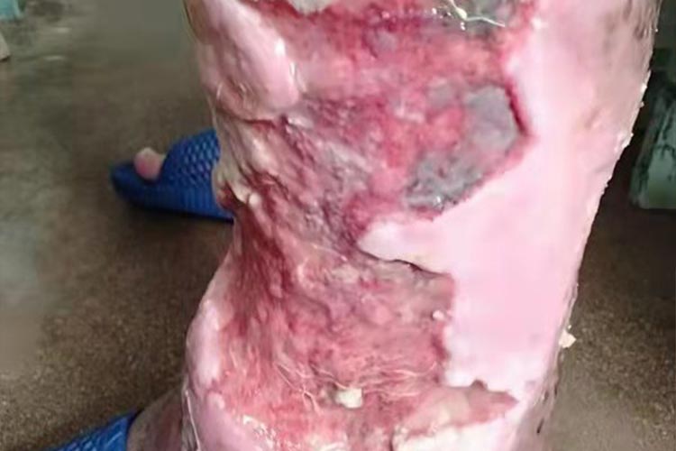 镰疮腿图