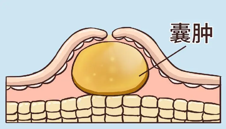 皮脂腺囊肿的症状有哪些？