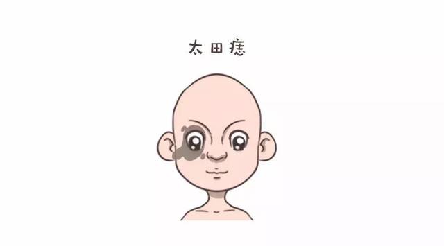 太田痣的症状有哪些