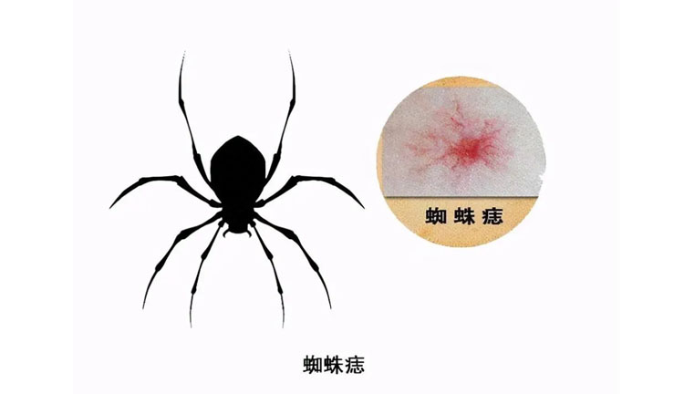 蜘蛛痣的症状有哪些