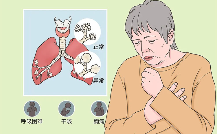 肺炎有哪些征兆和症状