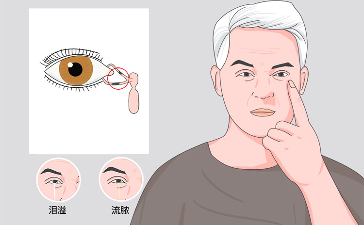 泪腺炎的症状有哪些