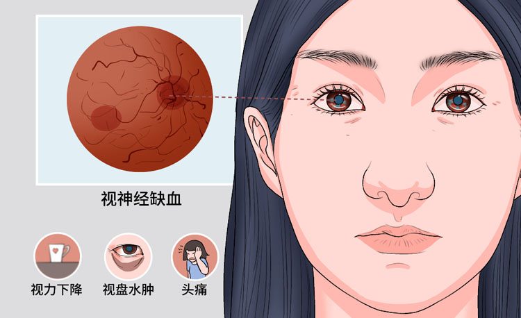 球后视神经炎的症状有哪些