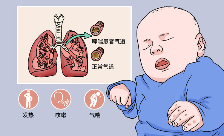 什么是支气管扩张？支气管扩张病因有哪些啊？