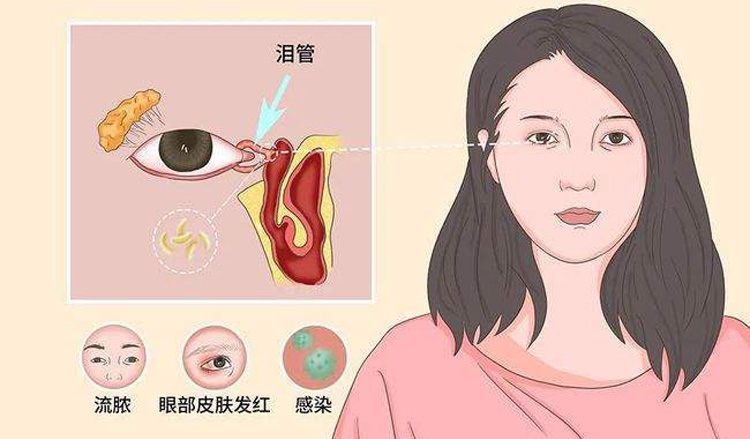 泪囊炎的症状有哪些