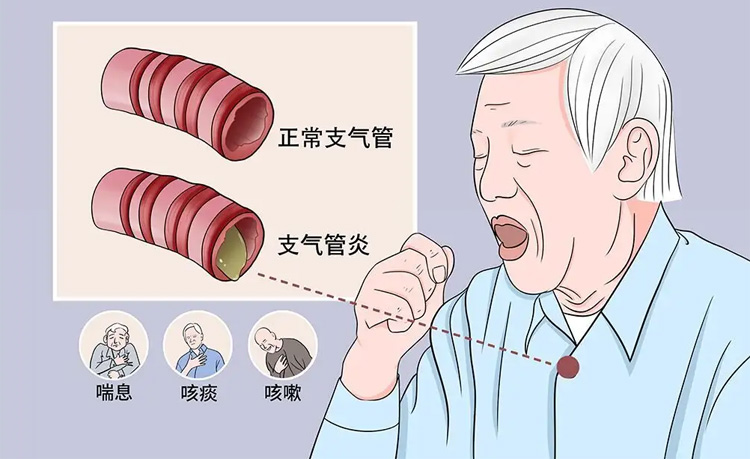 急性支气管炎的用什么药