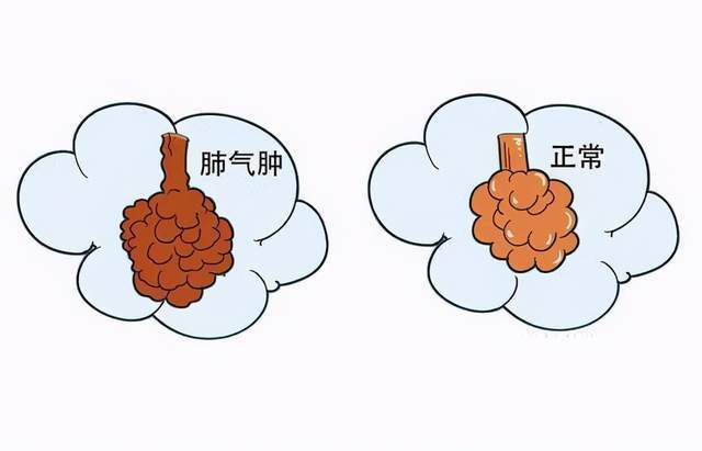 出现肺气肿的症状是什么