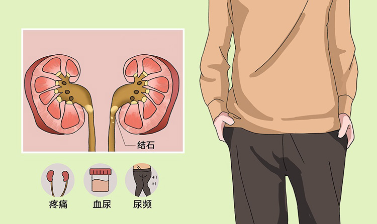 肾结石的症状有哪些