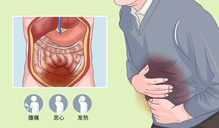 胆汁性腹膜炎的症状有哪些