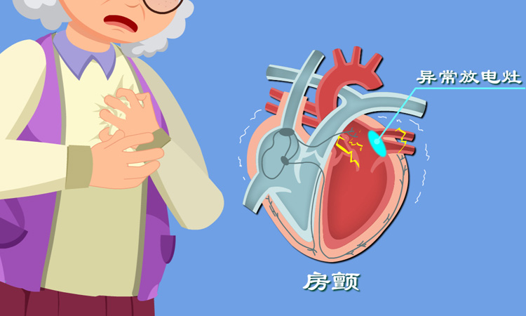 心房颤动的症状有哪些