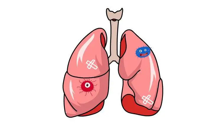 病毒性肺炎是怎么引起的