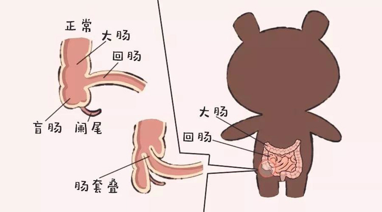 肠套叠的症状有哪些
