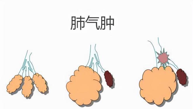 肺气肿是怎么引起的