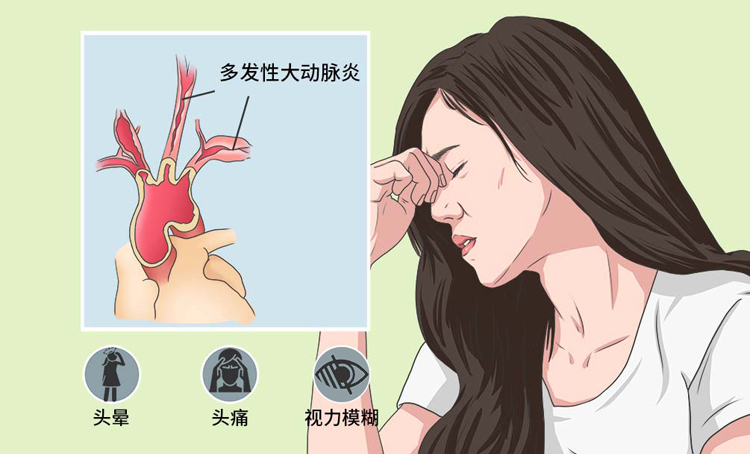 大动脉炎的症状有哪些