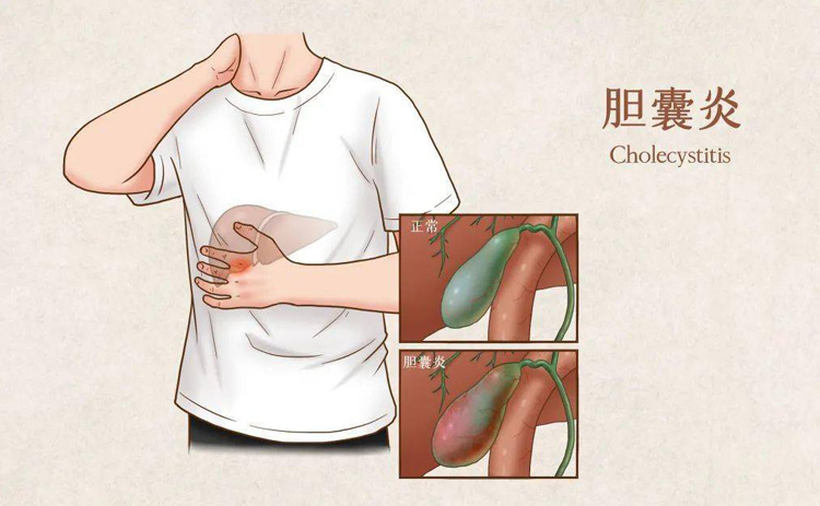胆囊炎如何预防