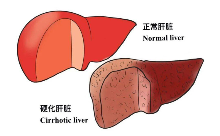 胆汁性肝硬化的症状有哪些