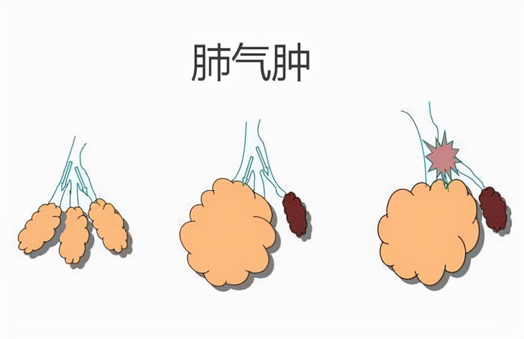 肺气肿是什么原因导致的