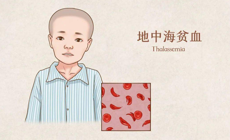 地中海贫血的症状有哪些
