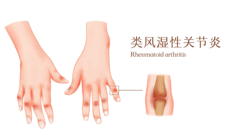 类风湿有哪些症状