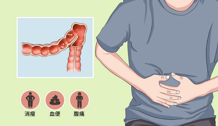 如何早期发现及预防胃肠癌