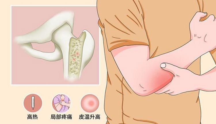 骨髓炎的症状有哪些