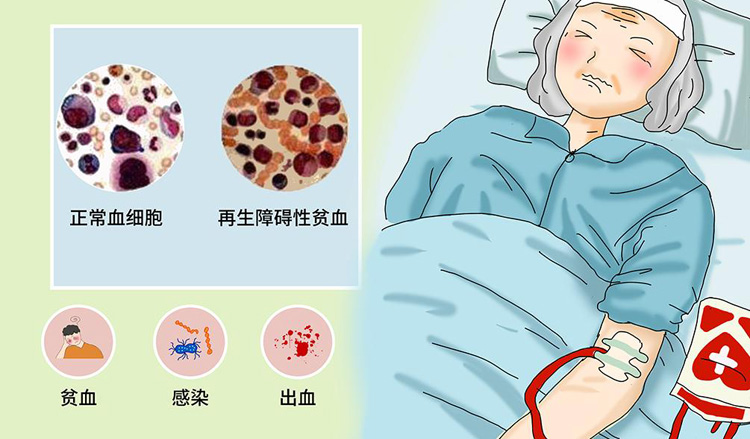 骨髓增生异常综合征的症状有哪些