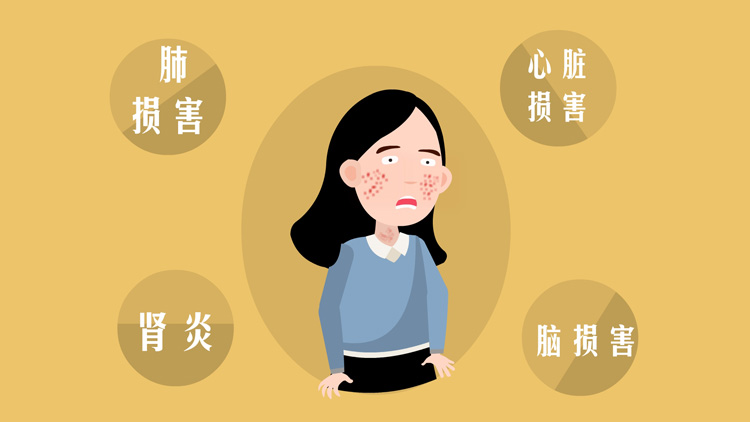 红斑狼疮的症状有哪些