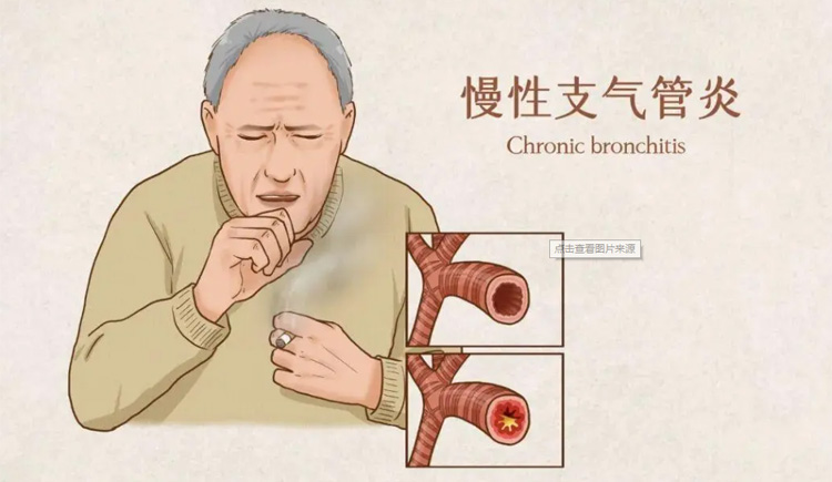 慢性支气管炎是怎么回事