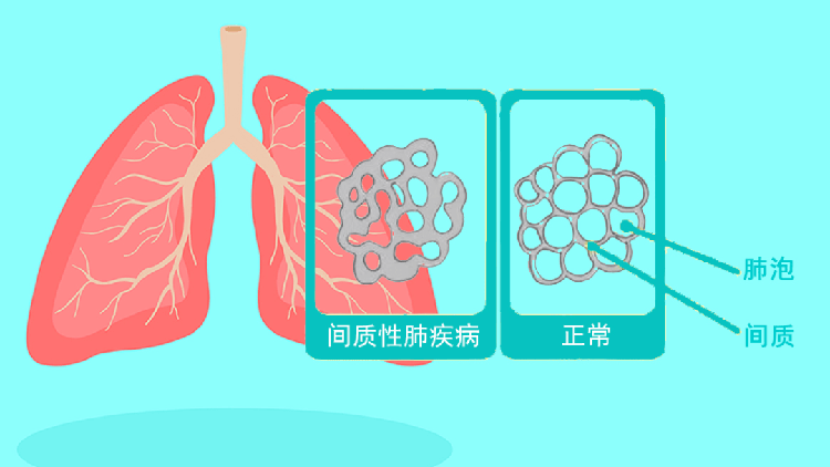 间质性肺病的症状有哪些