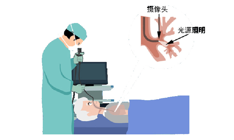 支气管镜检查术前要注意什么