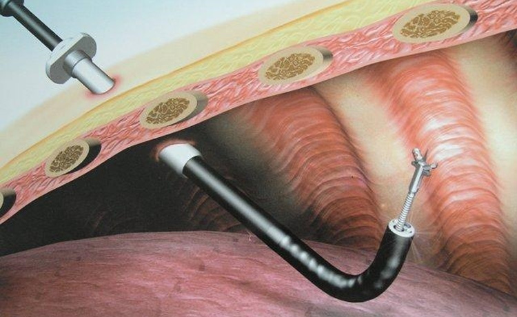 什么是内科胸腔镜