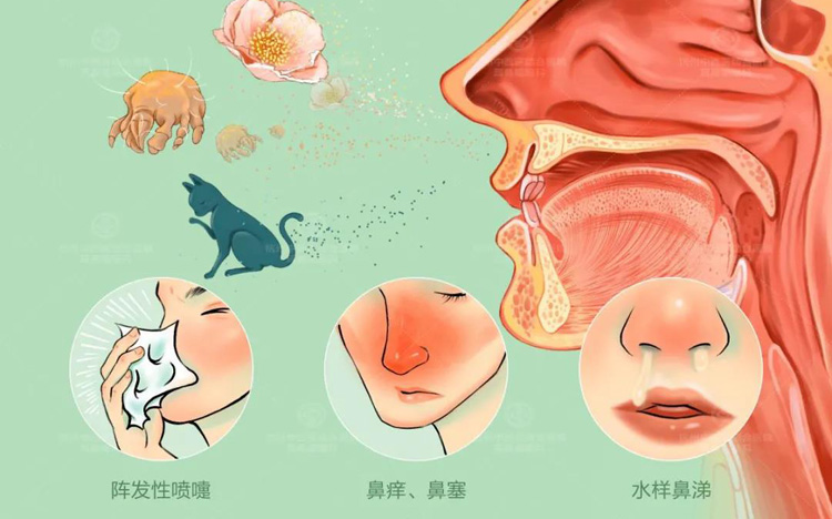 婴儿过敏性鼻炎如何用药