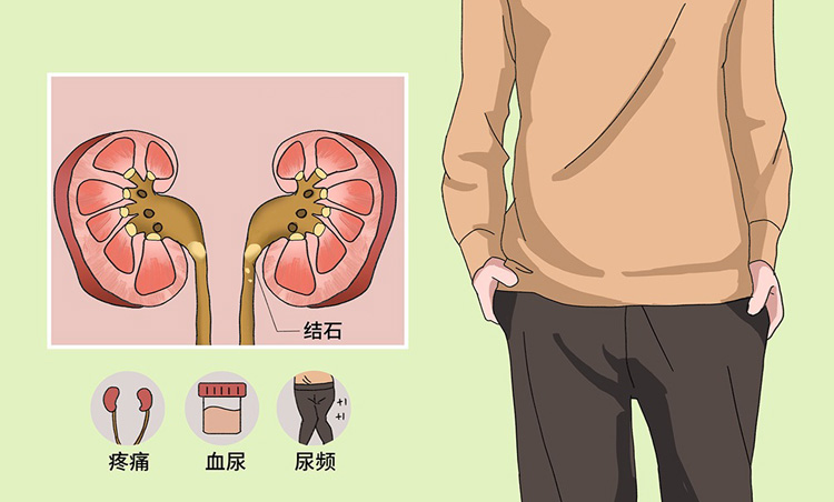 肾结石都有哪些症状