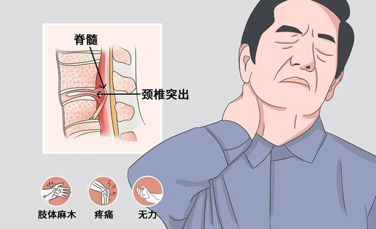脊髓型颈椎病有哪些症状