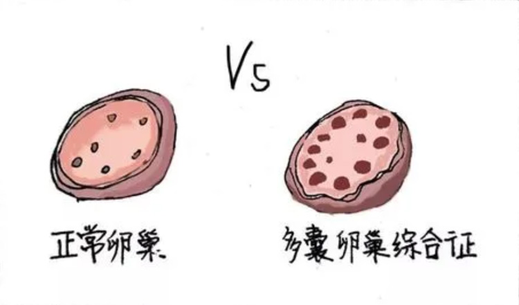 多囊卵巢综合征的症状