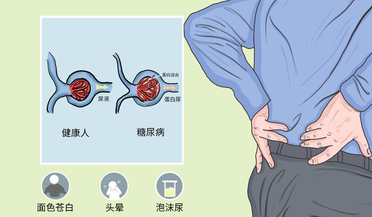 糖尿病肾病有哪些症状