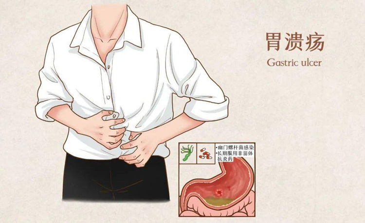 胃溃疡的症状有哪些
