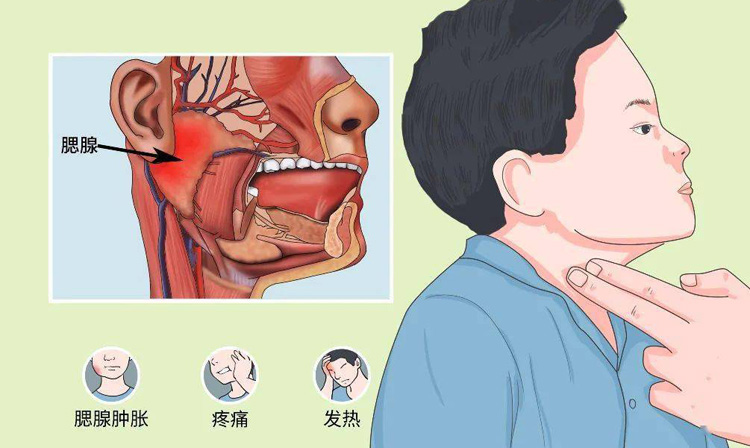 流行性腮腺炎有哪些症状