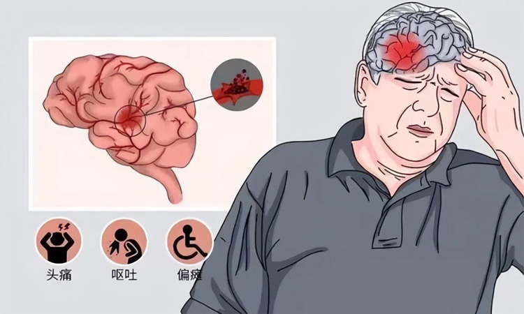 脑梗的症状有哪些