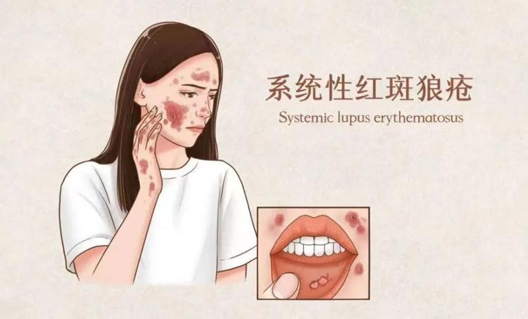 系统性红斑狼疮的症状有哪些