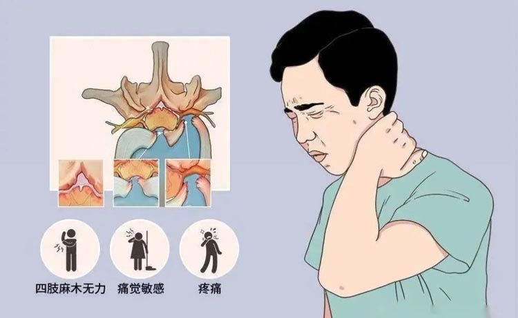 颈椎病的症状有哪些