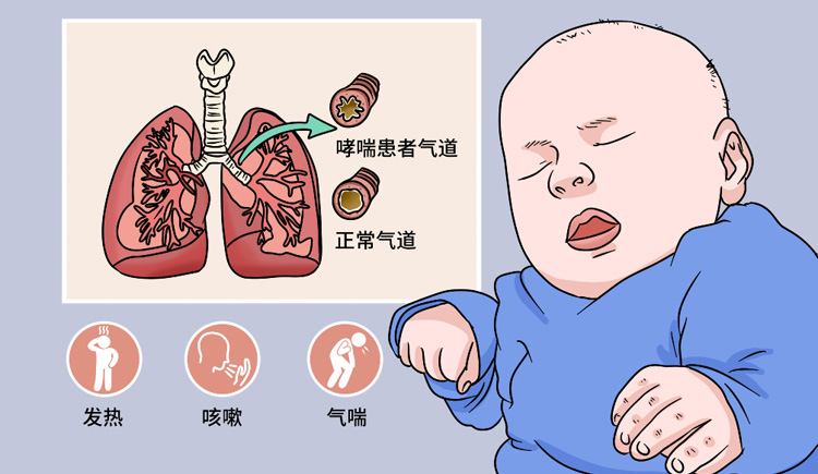 支气管哮喘有哪些症状
