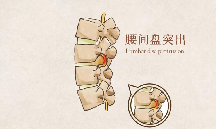 腰椎间盘突出的症状有哪些