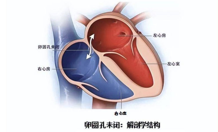 卵圆孔未闭有什么危害