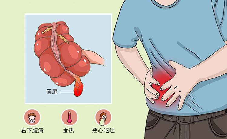 急性阑尾炎的症状有哪些