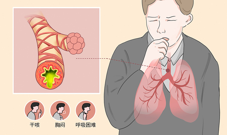 反复咳嗽警惕变异性哮喘