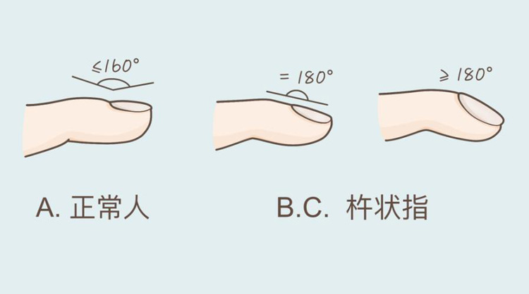 肺有没有问题，学会这“四看”