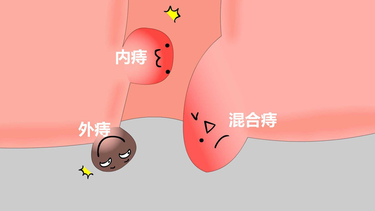 内痔和外痔有什么区别