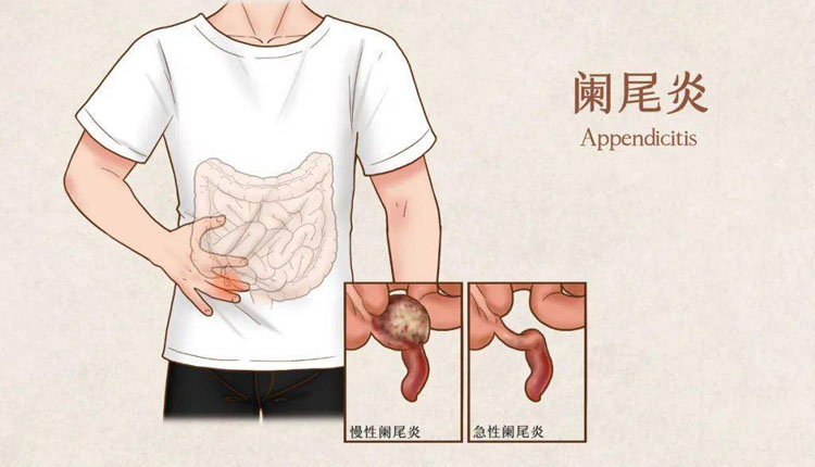 阑尾炎有哪些症状