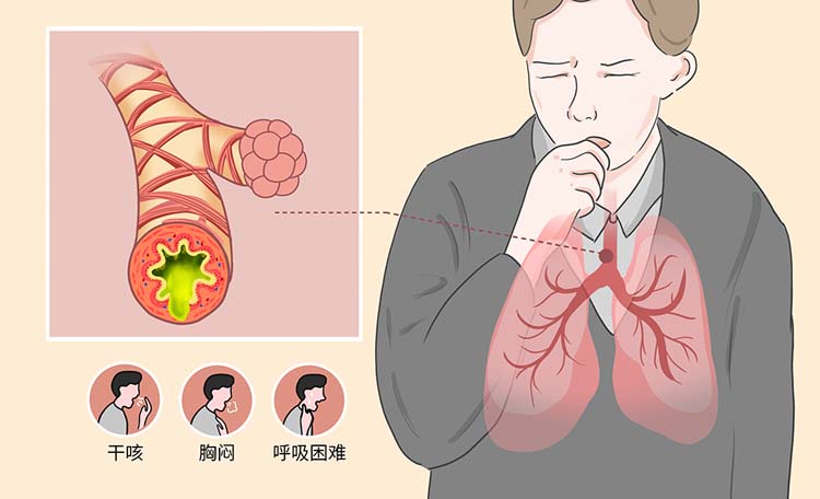 咳嗽变异性哮喘有什么症状